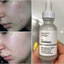 The Ordinary Niacinamide 10% + Zinc 1% – 30ml | Best Quality Niacinamide Serum